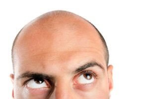 Financing Hair Loss Restoration Procedures
